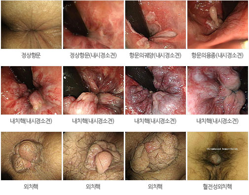 치핵 분류별 사진