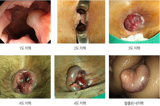 치핵의 정도와 증상 사진