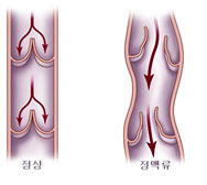 정상과 하지정맥류