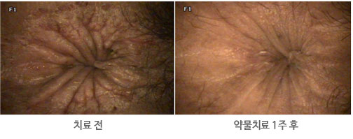 약물 치료 전후 사진