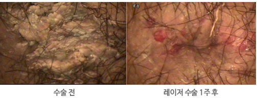 곤지름의 수술 전 후 사진