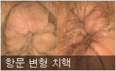 항문 변형 치핵