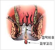 만성치열