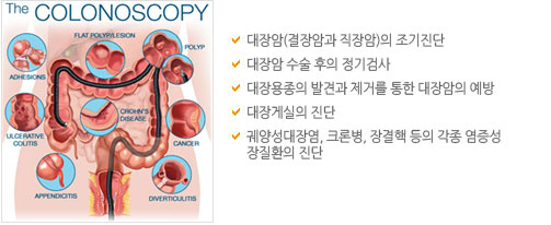 대장내시경 검사 목적