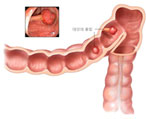 폴립절제술