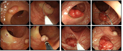내시경적 폴립절제술 사진